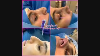 جراحی زیبایی بینی توسط رفیع پرنیا کربوکسی تراپی