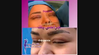 جراحی پلک توسط رفیع پرنیا رفع چین و چروک