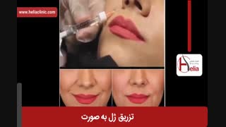 تزریق ژل | فیلم تزریق ژل | کلینیک پوست و مو هلیا | شماره 18