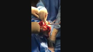 تعویض مفصل زانو در خانمی با آرتروز شدید زانو همراه با انحراف شدید