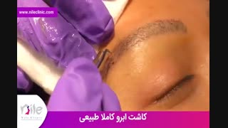 کاشت ابرو | فیلم کاشت ابرو | کلینیک پوست و مو نیل | شماره 20