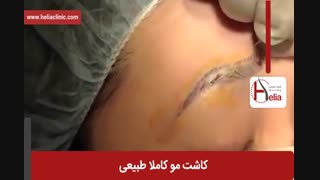 کاشت ابرو | فیلم کاشت ابرو | کلینیک پوست و مو هلیا | شماره 20