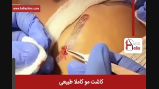 کاشت ابرو | فیلم کاشت ابرو | کلینیک پوست و مو هلیا | شماره 21