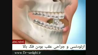 ارتودنسی و جراحی عقب بودن فک بالا