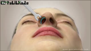 عمل زیبایی بینی