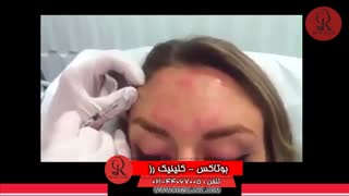 تزریق بوتاکس | فیلم تزریق بوتاکس | کلینیک پوست و مو رز | شماره 24