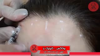 تزریق بوتاکس | فیلم تزریق بوتاکس | کلینیک پوست و مو رز | شماره 25