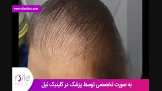 کاشت مو | فیلم کاشت مو | کلینیک پوست و مو نیل | شماره 22