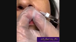 تزریق ژل برای رفع خط خنده پوسیدگی دندان