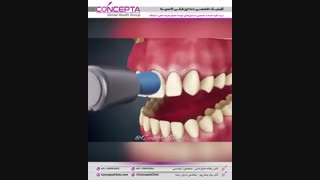 سفید کردن دندان (بلیچینگ) | کلینیک کانسپتا کاشت ابرو