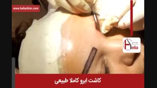 کاشت ابرو | فیلم کاشت ابرو | کلینیک پوست و مو هلیا | شماره 22