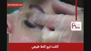 کاشت ابرو | فیلم کاشت ابرو | کلینیک پوست و مو هلیا | شماره 25
