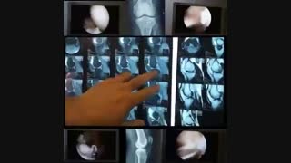 بازسازی همزمان رباط صلیبی قدامی و خلفی