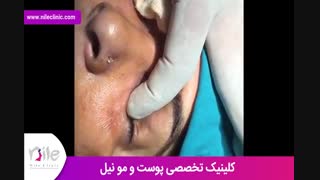 تزریق چربی | فیلم تزریق چربی | کلینیک پوست و مو نیل | شماره 17