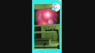 عمل سالپنژکتومی برداشتن لوله رحمی