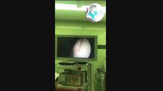 عمل لاپاراسکوپی کیست تخمدان