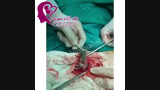 جراحی کیست درموئید تخمدان