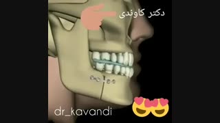 جراحی فک بالا و پایین | دکتر فرشید کاوندی ارتودنسی