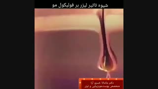 فیلم تاثیر لیزر بر فولیکول مو