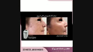 لیزر آپوجی پلاس ۲۰۱۹