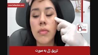 تزریق ژل | فیلم تزریق ژل | کلینیک پوست و مو هلیا | شماره 24