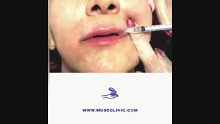 فرم دهی لب ها با فیلر هیالورونیک اسید