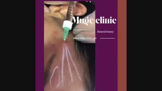 تزریق ژل به شقیقه