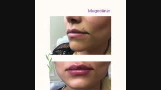 فرم دهی لب با تزریق ژل