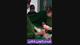 هیسترکتومی شکمی ( خارج کردن رحم)