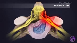 آسیب ریشه های عصبی گردن