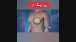 جراحی ژنیکوماستی