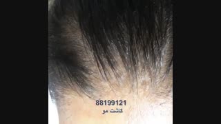 کاشت مو 88199121 ونک  نگار مو