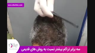 کاشت مو | فیلم کاشت مو | کلینیک پوست و مو نیل | شماره 24