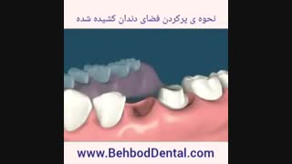 نحوه پر کردن فضای دندان کشیده شده