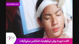 کاشت ابرو | فیلم کاشت ابرو | کلینیک پوست و مو نیل | شماره 27
