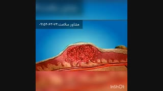 راه درمان زگیل تناسلی را از ما بخواهید