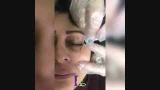 فیلم برداشت خال با لیزر جراحی لثه