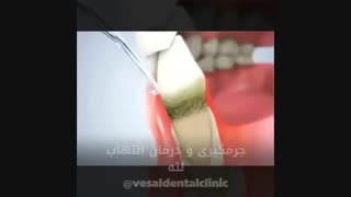 فیلم جرمگیری