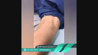 فیلم جراحی خشکی مفصل زانو