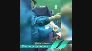 عمل زانوی پرانتزی