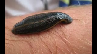 آیا زالو گرفتگی رگ ها را برطرف می کند؟