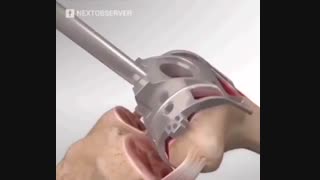 جراحی تعویض مفصل زانو