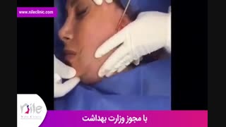 لیپوماتیک | فیلم لیپوماتیک | کلینیک پوست و مو نیل | شماره 22