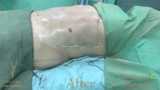 ازالة الدهون من البطن و الخصر