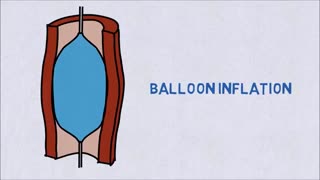 آنژیوگرافی قلب چگونه است؟