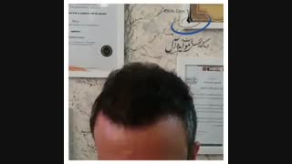 شش ماه بعد از کاشت موی سر