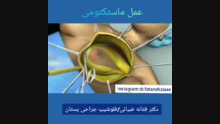 فیلم عمل ماستکتومی پستان