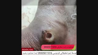 درمان زخم دیابتی توسط تیم تحقیقاتی فردوسی 09305011016