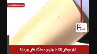 لیزر موهای زائد | فیلم لیزر موهای زائد | کلینیک پوست و مو هلیا | شماره 28