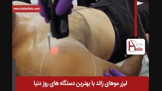 لیزر موهای زائد | فیلم لیزر موهای زائد | کلینیک پوست و مو هلیا | شماره 29